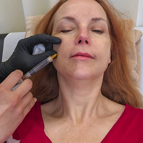 Skin boosters in London review