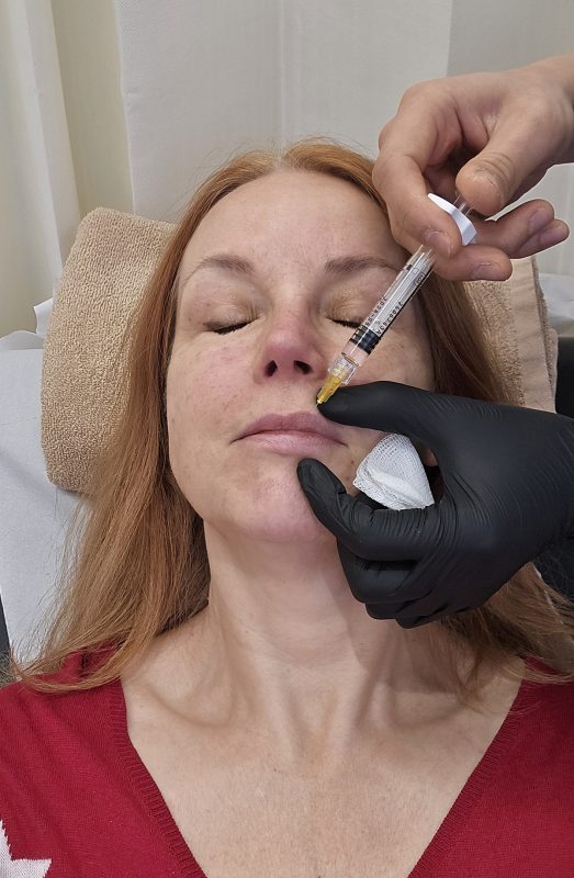 Naso-labial fold injection